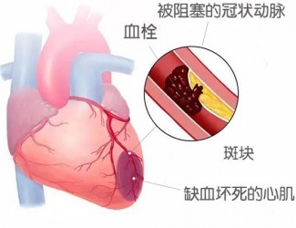 血栓的形成原因及后果，如何預(yù)防血栓導(dǎo)致的疾病